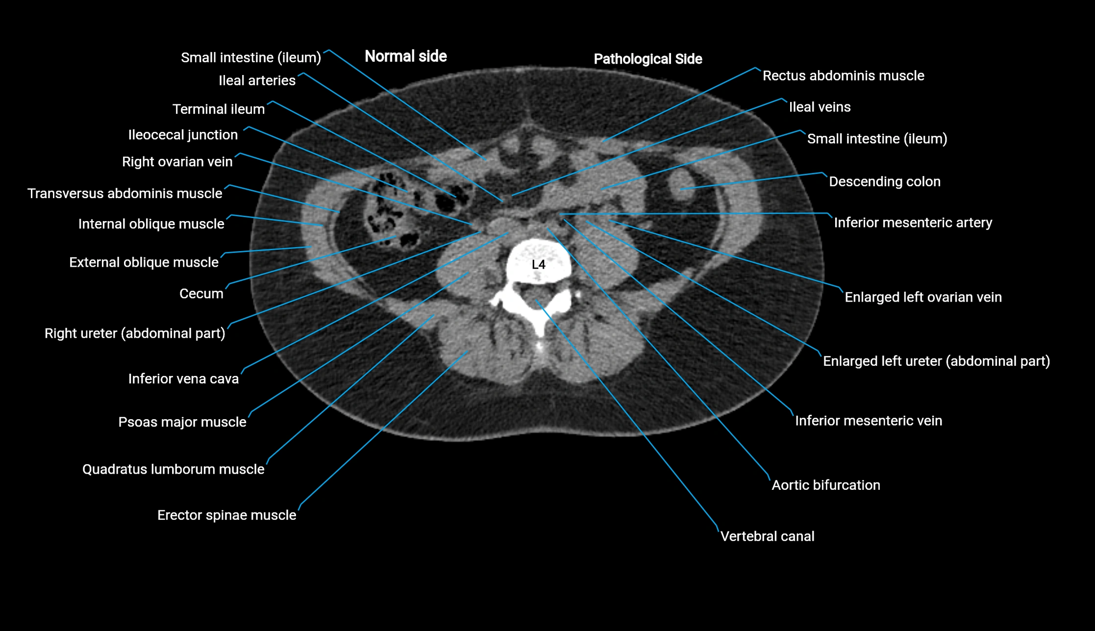 CT KUB axial cross sectional anatomy  radiology image -img-00201-00089.webp